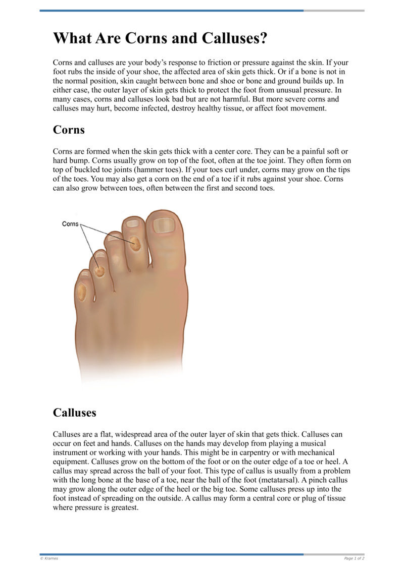 PDF What Are Corns and Calluses? HealthClips Online