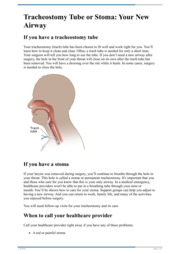 Thumbnail image for "Tracheostomy Tube or Stoma: Your New Airway"