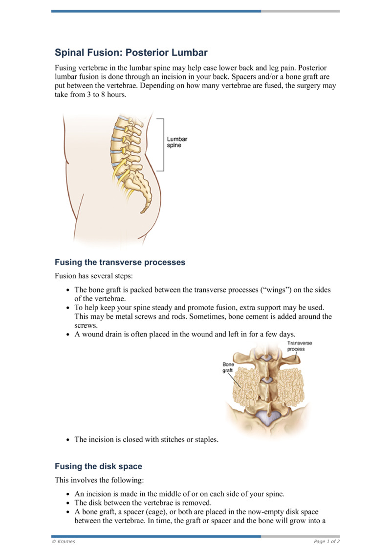 PDF - Spinal Fusion: Posterior Lumbar - HealthClips Online