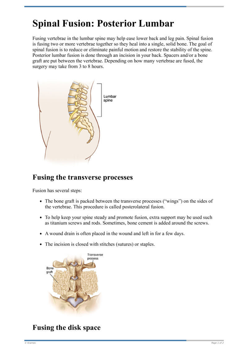 Text - Spinal Fusion: Posterior Lumbar - HealthClips Online