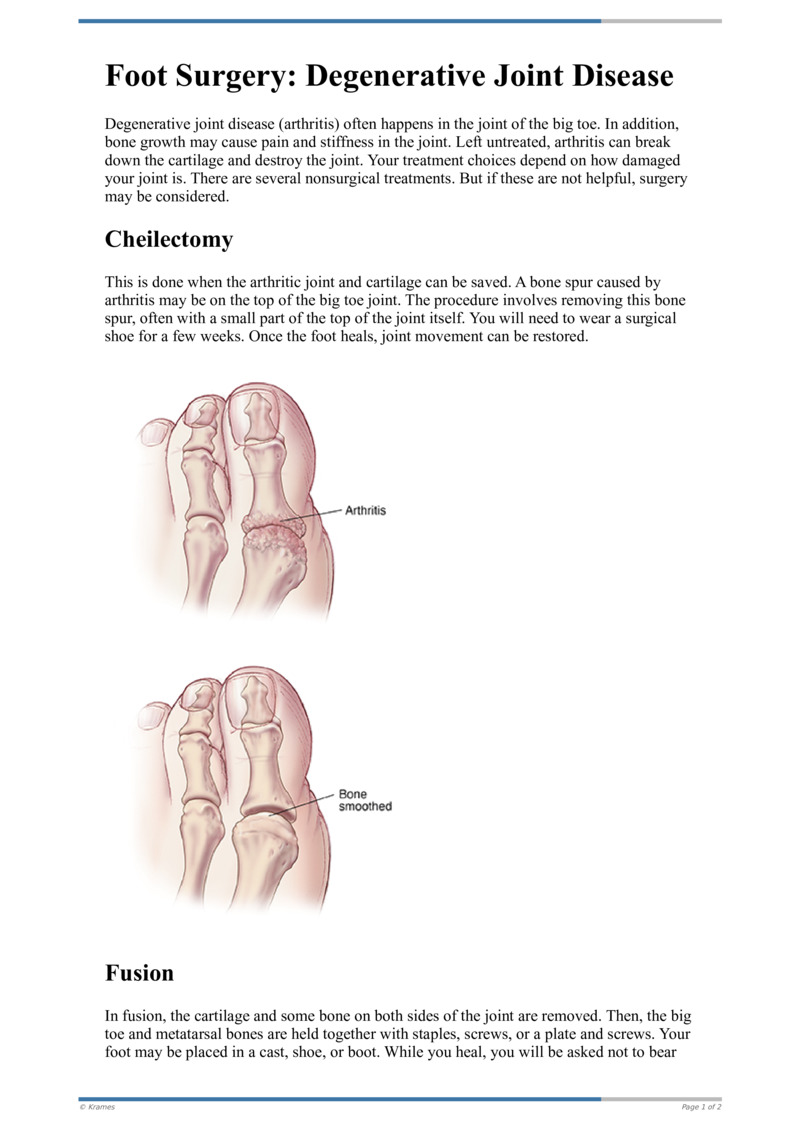 text-foot-surgery-degenerative-joint-disease-healthclips-online