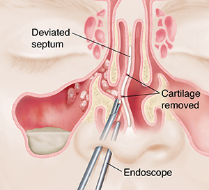 Text - Endoscopic Sinus Surgery