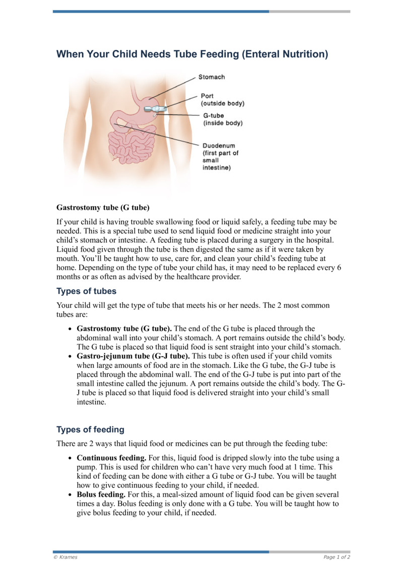 PDF When Your Child Needs Tube Feeding (Enteral Nutrition