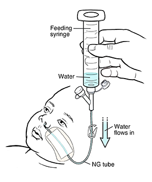 Text - Your Child's Nasogastric Tube: Flushing the Tube
