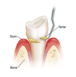 Side view of tooth in bone with instrument doing scaling.
