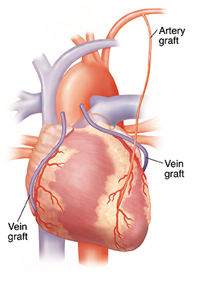 健康・医学 Off-Pump Coronary Artery Bypass Off-Pump Coronary Artery Bypass Surgery | Circulation