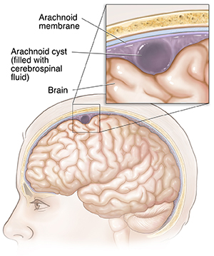 Text - Arachnoid Cyst - HealthClips Online