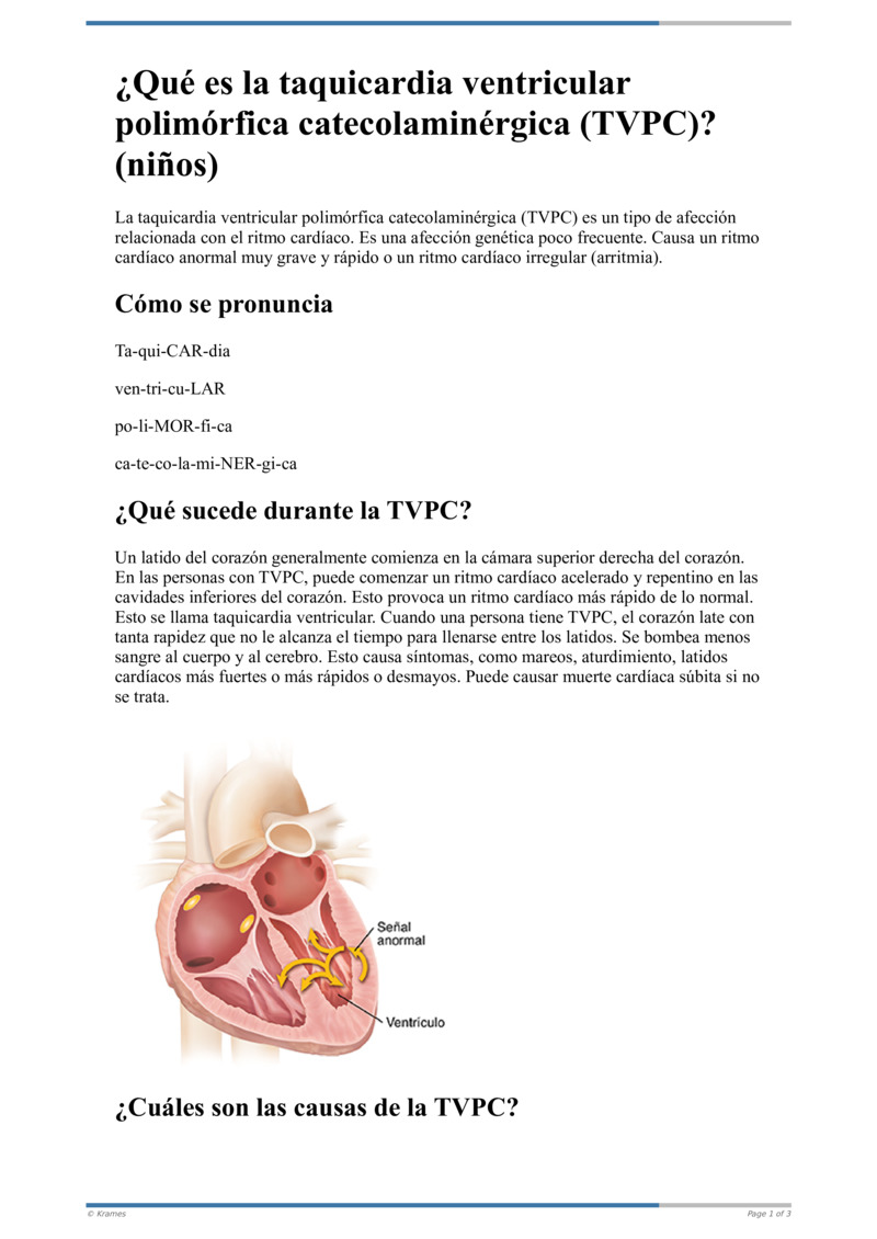 taquicardia ventricular polimórfica