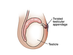 Testicular Appendage Testicular Pain, Disorders: Right Or Left