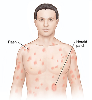 Chest Rash Causes