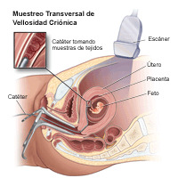 Ilustración que demuestra un muestreo de vellosidad coriónica transcervical