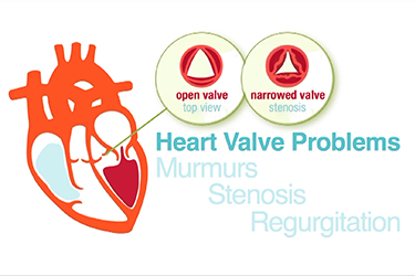 Thumbnail image for "What is a Heart Murmur and How Does It Relate to Valve Problems"