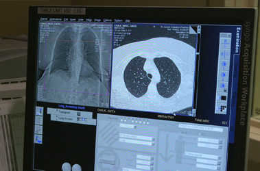 Thumbnail image for "The Importance of Lung Cancer Screening"