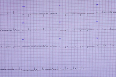 Thumbnail image for "What is an ECG/EKG (Electrocardiogram)?"