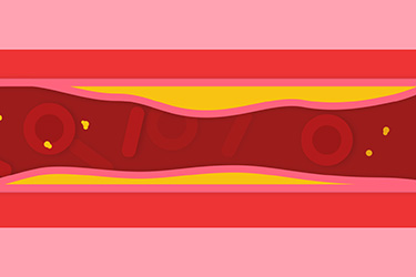 Thumbnail image for "Understanding High Blood Cholesterol"