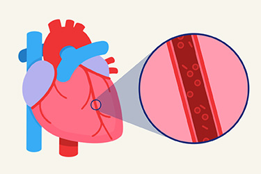 Thumbnail image for "Cholesterol Medicines: Understanding Statins"