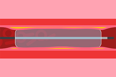 Thumbnail image for "Treating Coronary Artery Disease: Medicines, Stents and Surgery"