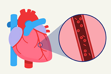Thumbnail image for "Taking Statins After a Heart Attack"