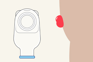 Thumbnail image for "Your Care at Home: Colostomy Care"