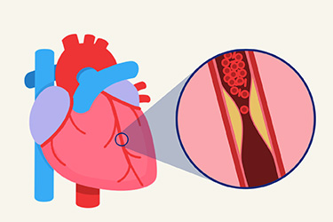 Thumbnail image for "Emergency Treatment for a Heart Attack: Get Help Quickly"