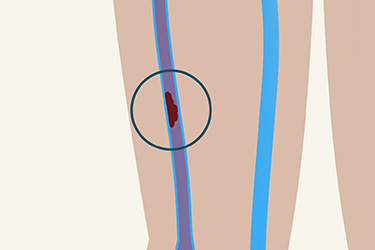 Thumbnail image for "What is Deep Vein Thrombosis?"