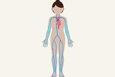 Thumbnail image for "Preventing Deep Vein Thrombosis (DVT): After Your Hospital Stay"