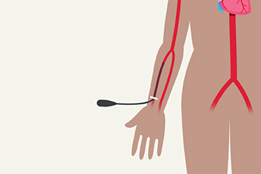 Thumbnail image for "¿Qué es una Angiografía Coronaria?"