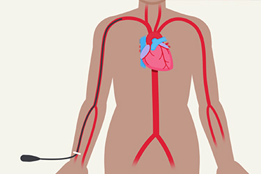 Thumbnail image for "Beneficios y Riesgos de la Angiografía Coronaria"