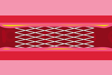 Thumbnail image for "What is Coronary Angioplasty?"