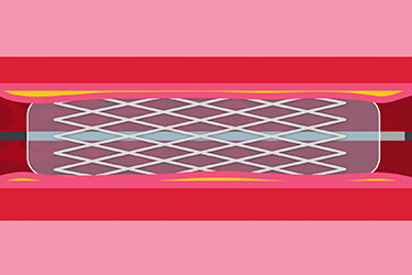 Thumbnail image for "What is a Heart Stent?"