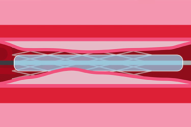 Thumbnail image for "After Angioplasty: What is Restenosis?"