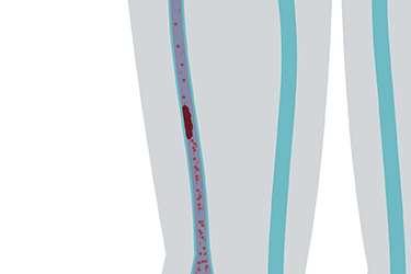 Thumbnail image for "Enoxaparin"