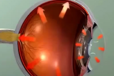 Thumbnail image for "Animation: Glaucoma"