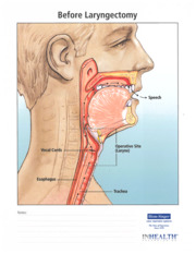 Thumbnail image for "Before Laryngectomy"