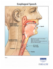 Thumbnail image for "Esophageal Speech"