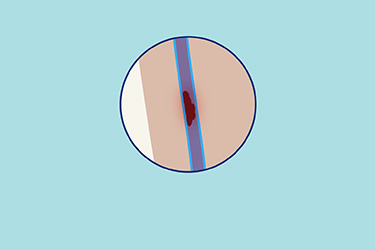 Thumbnail image for "Five Ways to Prevent DVT while Traveling"