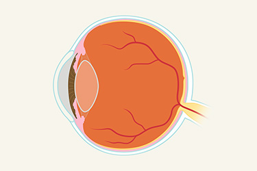 Thumbnail image for "Diabetes-Related Eye Diseases"