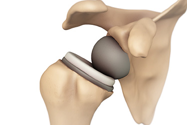 Thumbnail image for "Shoulder Replacement: Before Your Surgery "