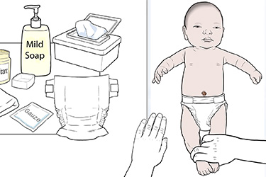 Thumbnail image for "Step-by-Step: Caring For Your Newborn's Circumcision"