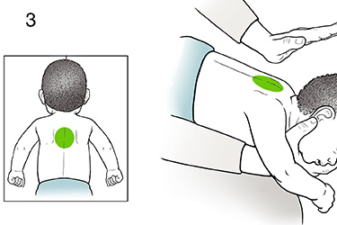 Thumbnail image for "Step-by-Step: Choking Rescue for a Baby (0-1 Year of Age)"
