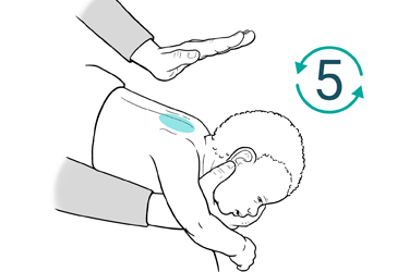 Thumbnail image for "Step by Step: Choking Rescue for a Baby (0-1 Year of Age)"