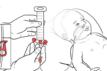 Thumbnail image for "Step-by-Step: Feeding a Baby with an NG Tube"