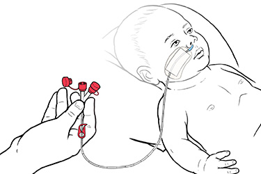 Thumbnail image for "Paso a Paso: Alimentando al Bebé con una Sonda NG"