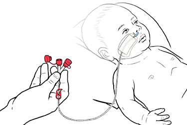 Thumbnail image for "Step-by-Step: Gravity Feeding a Baby with an NG Tube"