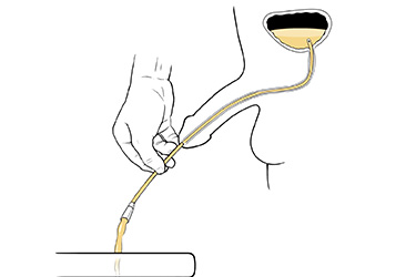 Thumbnail image for "Step-by-Step: Inserting a Disposable Catheter (For Penis)"