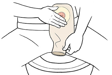 Thumbnail image for "Step-by-Step: Stoma Care: Emptying the Pouch"