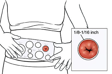 Thumbnail image for "Step-by-Step: Stoma Care: Sizing the Opening"