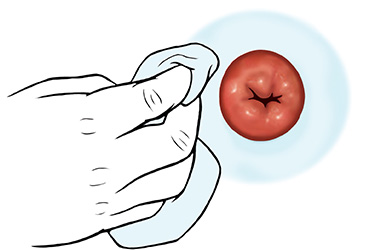 Thumbnail image for "Step-by-Step: Stoma Care: Your Stoma and Skin"