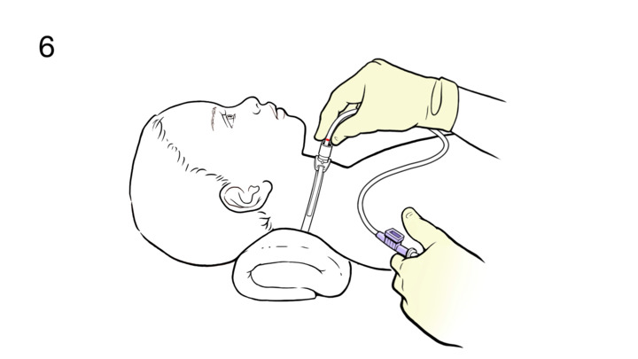 Video - Step-by-Step: Suctioning a Child's Tracheostomy - HealthClips ...