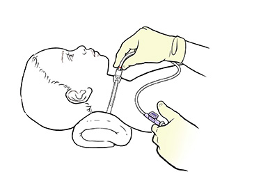 Thumbnail image for "Step-by-Step: Suctioning a Child's Tracheostomy"